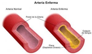 arteriosclerosis y alimentación