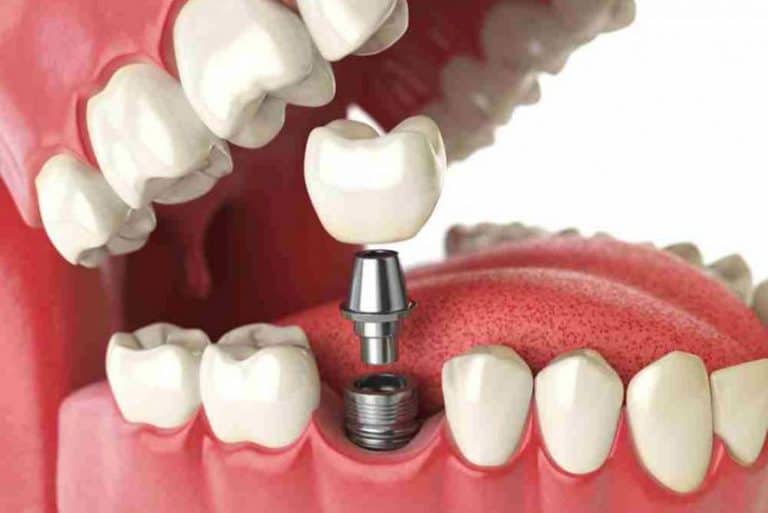 implante dental barcelona